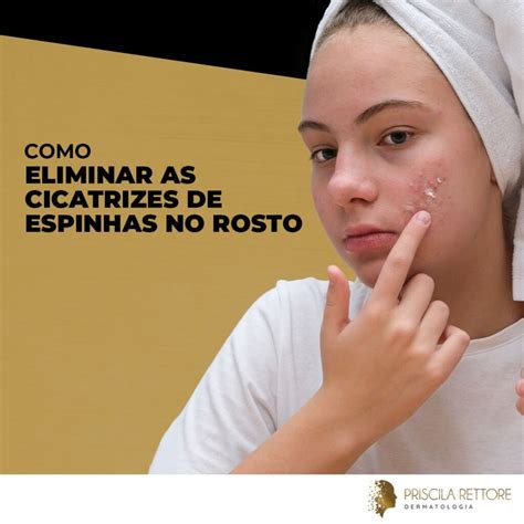 Como Eliminar As Cicatrizes De Espinhas No Rosto Dra Priscila Rettore