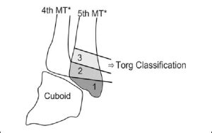 Torg Classification For Fifth Metatarsal Fractures Dr Steve Edwards