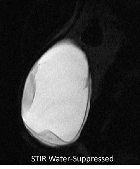 Mri Intracapsular Rupture Breast Rads