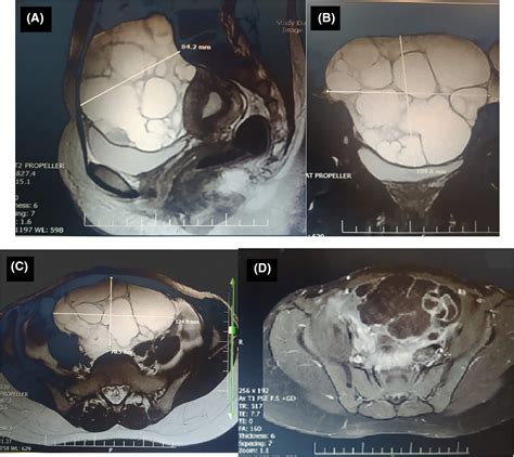 Primary Pelvic Hydatid Cyst In An Infertile Female A Case Report Ghafouri 2020 Clinical