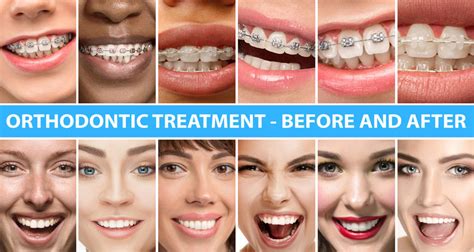 Smiledirectclub Vs Invisalign Which Is Better In