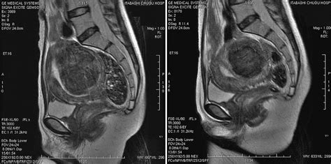 Non Invasive Magnetic Resonance Imaging Guided Focused Ultrasound