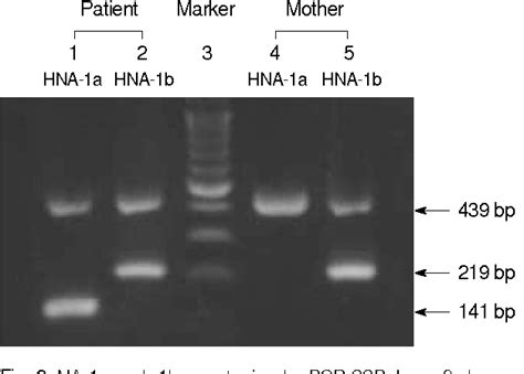 Figure 2 From A Case Of Neonatal Alloimmune Neutropenia Associated With