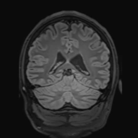 Focal Cortical Dysplasia Bottom Of Sulcus Radiology Case