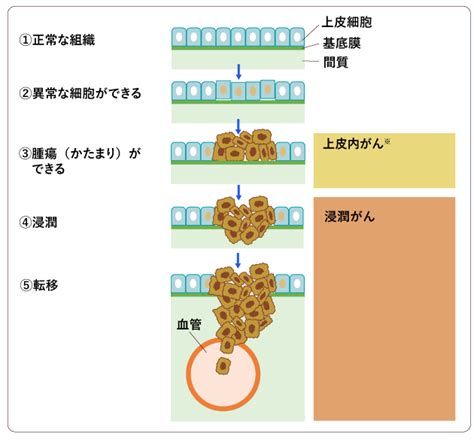 がんという病気について： 国立がん研究センター がん情報サービス 一般の方へ