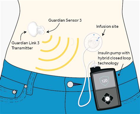 The semi-automated insulin pump performs well - GT health