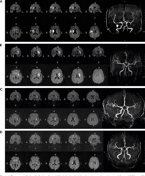 Figure 1 From Analysis Of The Lesion Distributions And Mechanism Of