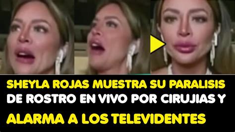 Sheyla Rojas Muestra Su Paralisis De Rostro En Vivo Por Cirujias Y