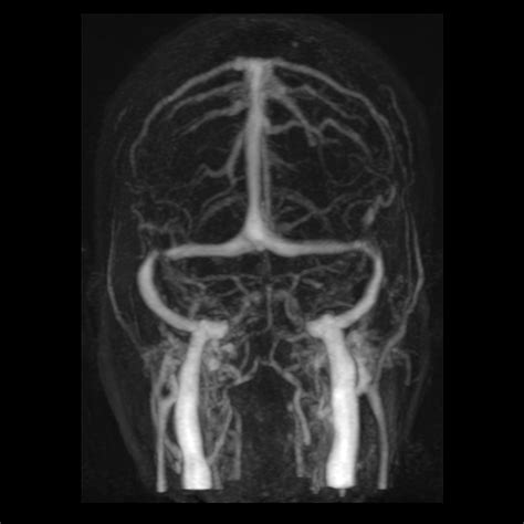 Idiopathic Intracranial Hypertension Image