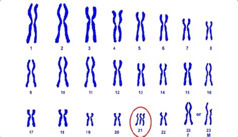 A karyogram of Down syndrome | Download Scientific Diagram