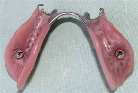 Implant Dentures (Partial) - Northland Prosthodontics - Northland ...