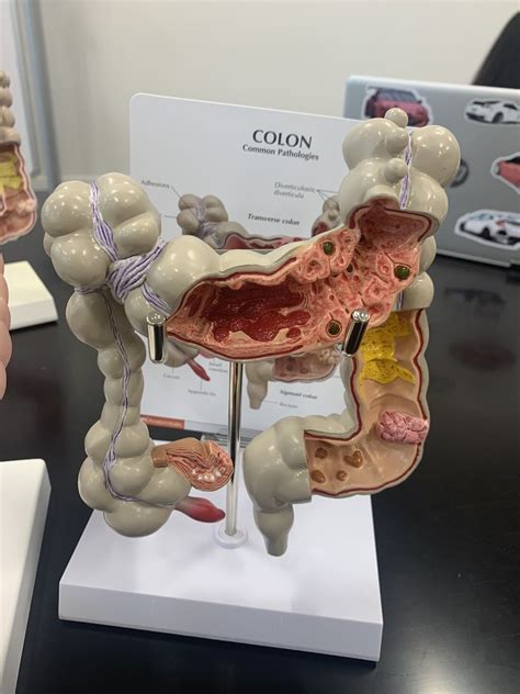 Colon Common Pathologies Diagram Quizlet