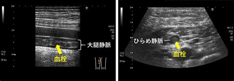 末梢血流、腹部大動脈血管エコー検査｜生理機能検査室｜中央診療部門 臨床検査部｜診療科・部門のご案内｜国立循環器病研究センター 病院