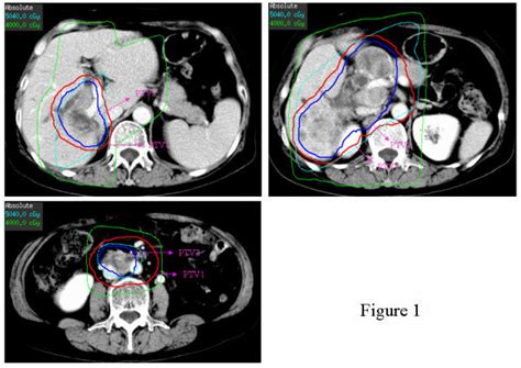 Three-dimensional conformal radiation therapy for intrahepatic... | Download Scientific Diagram