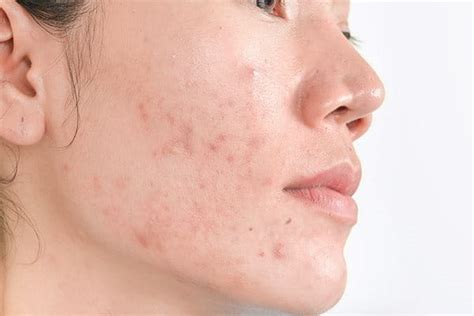 Post Inflammatory Hyperpigmentation Pih Eucerin