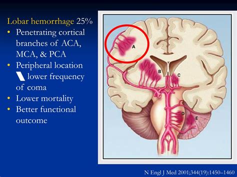 Ppt Understanding Intracranial Hemorrhage Mechanisms Clinical