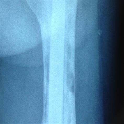 Aseptic Loosening Of The Cemented Stem In Patient No 5 Download Scientific Diagram