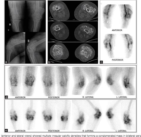 Figure From Bilateral Generalised Synovial Chondromatosis Of The Knee