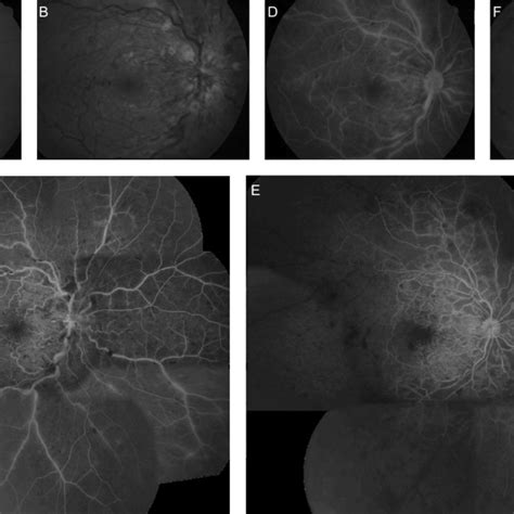 Fundus Photography A B And F And Fluorescein Angiography Fa C