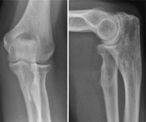 Radiographs At Final Follow Up Showed Good Fracture Healing And