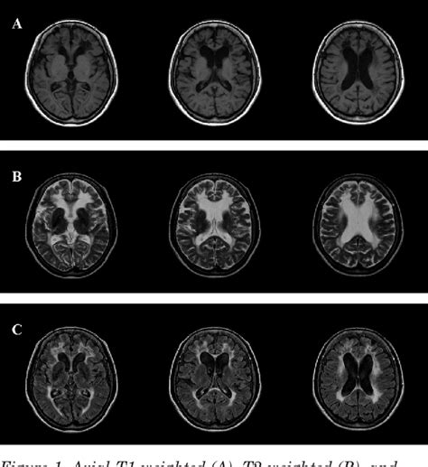 Figure From Adult Onset Leukoencephalopathy With Vanishing White