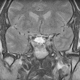 Precontrast T1 Weighted Sagittal Image Of The Brain Showing A Large