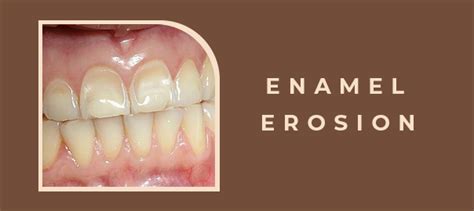 Enamel Erosion: Symptoms, Causes, Prevention, and Treatment