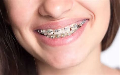 When Were Braces Invented A History Of Alignment Byte®