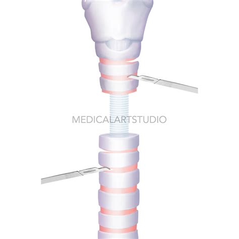 TRACHEA SURGERY on Behance