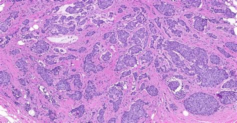 Invasive Ductal Carcinoma Histology