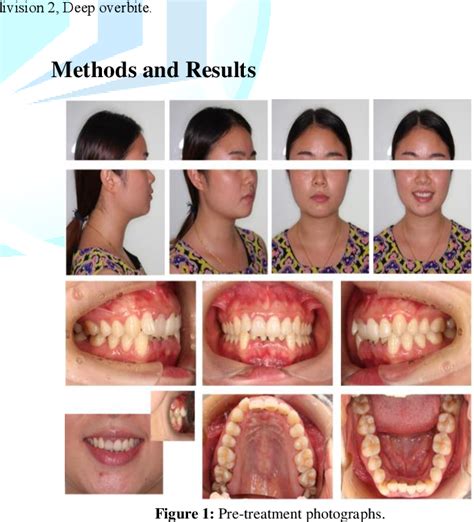 Figure 1 From Treatment Of The Deep Overbite Malocclusion With Lingual