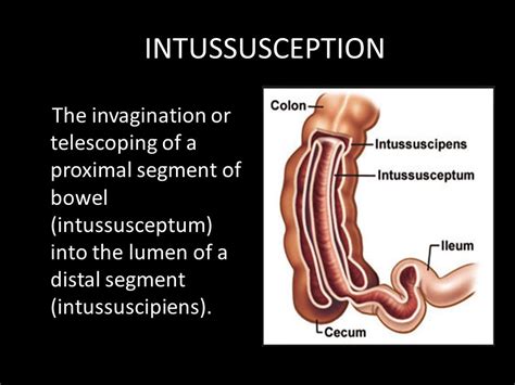 Telescoped Intestines Adults