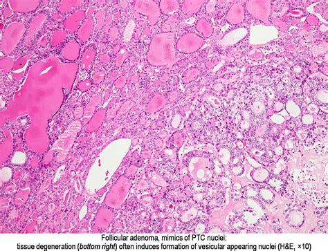 Pathology Outlines Papillary Thyroid Carcinoma Overview