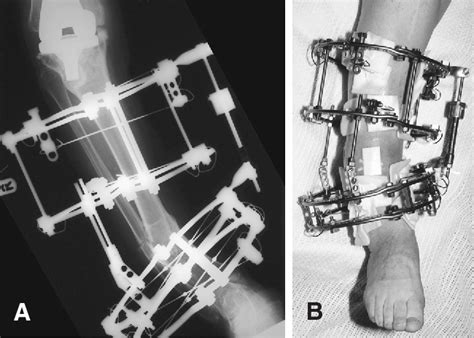 Figure From Use Of An Ilizarov Fixator For Deformity Correction Prior