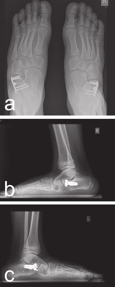 Postoperative Weightbearing Anterior Posterior View A And Lateral