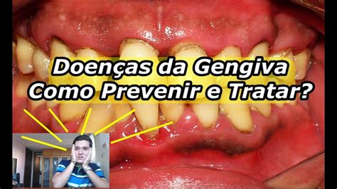 Doen As Da Gengiva O Que Como Prevenir E Tratar Resumo Youtube