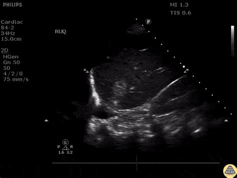 Gastrointestinal — Tpa