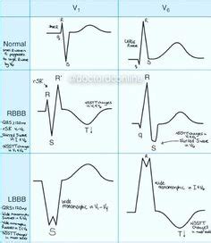 10 Best QRS Complex ideas | qrs complex, cardiac nursing, ekg