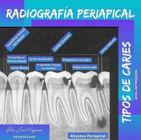 Radiograf A Periapical Radiologia Radiologia Odontologica