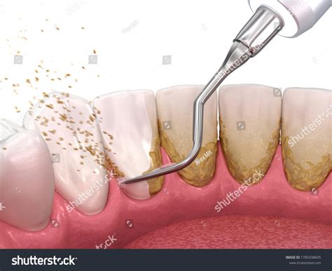 Periodontics Treatment Dental Clinics In Hyderabad Secunderabad