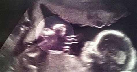 Amazing ultrasound shows ”angel” watching over unborn baby in mom’s womb