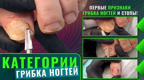 Категории грибка ногтей. Первые признаки грибка ногтей и стопы! - YouTube