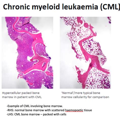 Haematological Malignancies Flashcards Quizlet