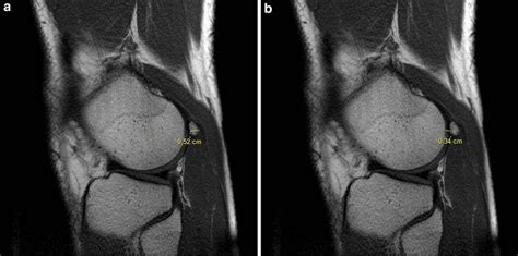 Sagittal T1 weighted MRI demonstrated os fabella a sagittal ...