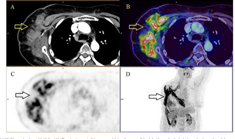 Figure From Reports Of Practical Oncology And Radiotherapy Case