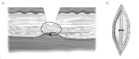 The Fascial Plication Suture An Adjunct To Layered Wound Closure