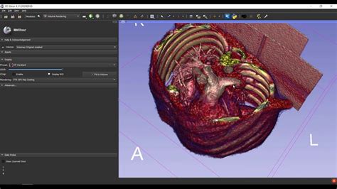 D Slicer Using A Segment Surface To Hollow A Volume Render Youtube