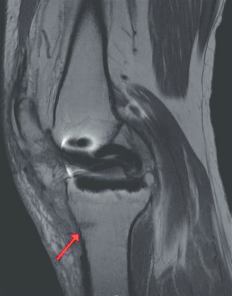 Sagittal Fast Spin Echomagnetic Resonance Image Of A Patient Presenting