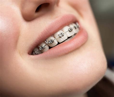 Dental Braces Amazing Smiles