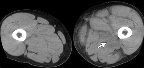 Retroperitoneal Fasciitis Spectrum Of Ct Findings In The Abdomen And Pelvis Radiographics